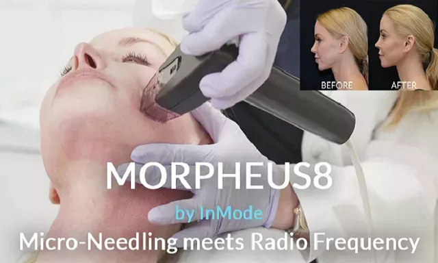 Ultherapy