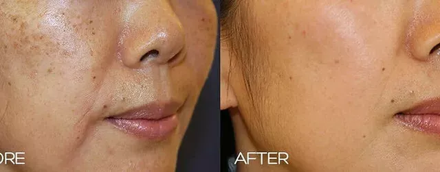 PicoSure laser device at See Beyond Beauty