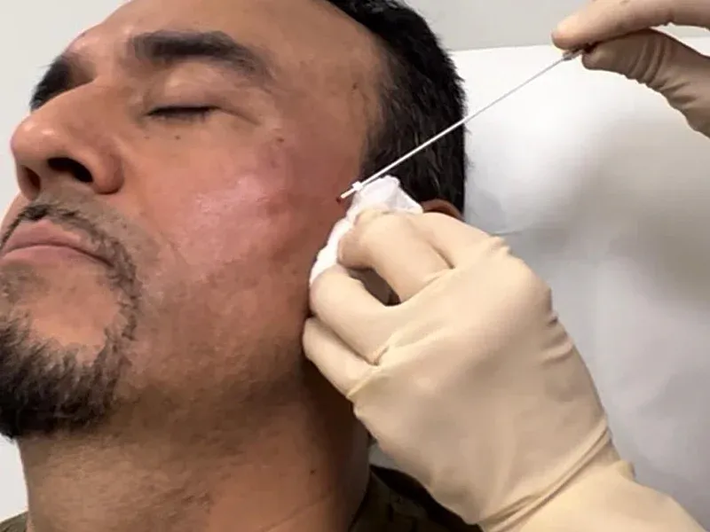 Non-Surgical Facelift - hero