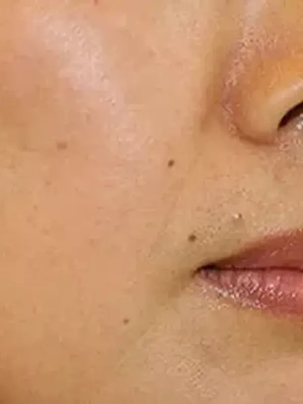 PicoSure - inline
