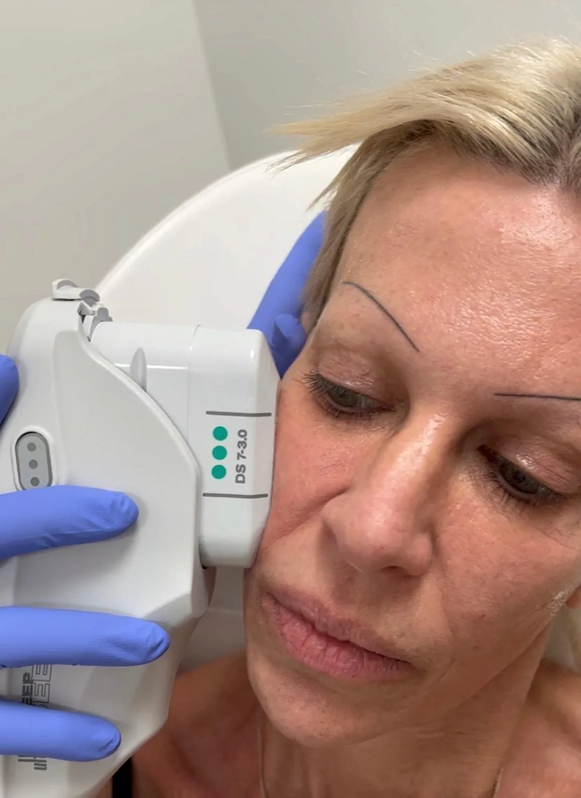 Ultherapy