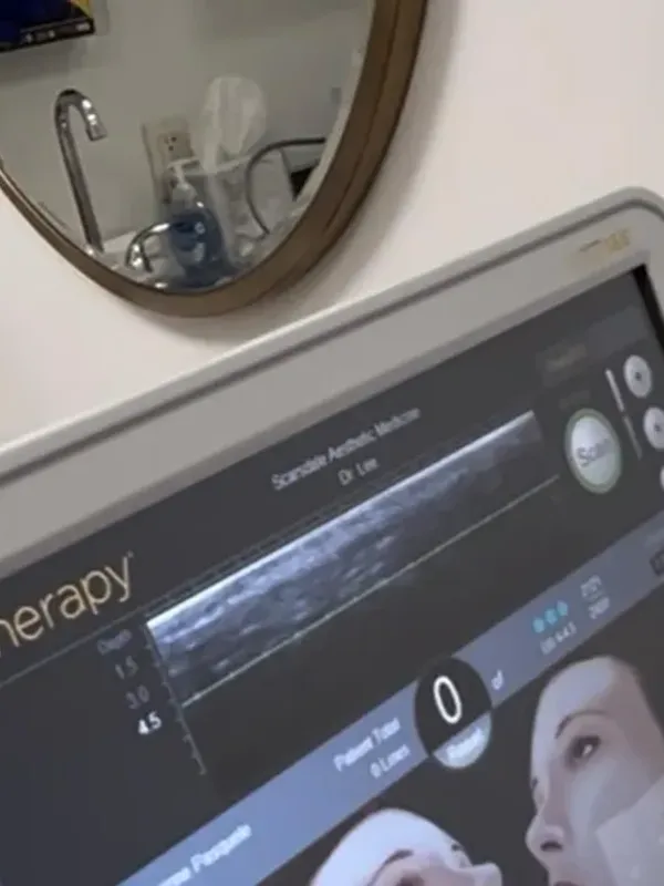Ultherapy - inline